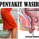 Illustration for article titled Penyakit Wasir Apa Obatnyaem/em